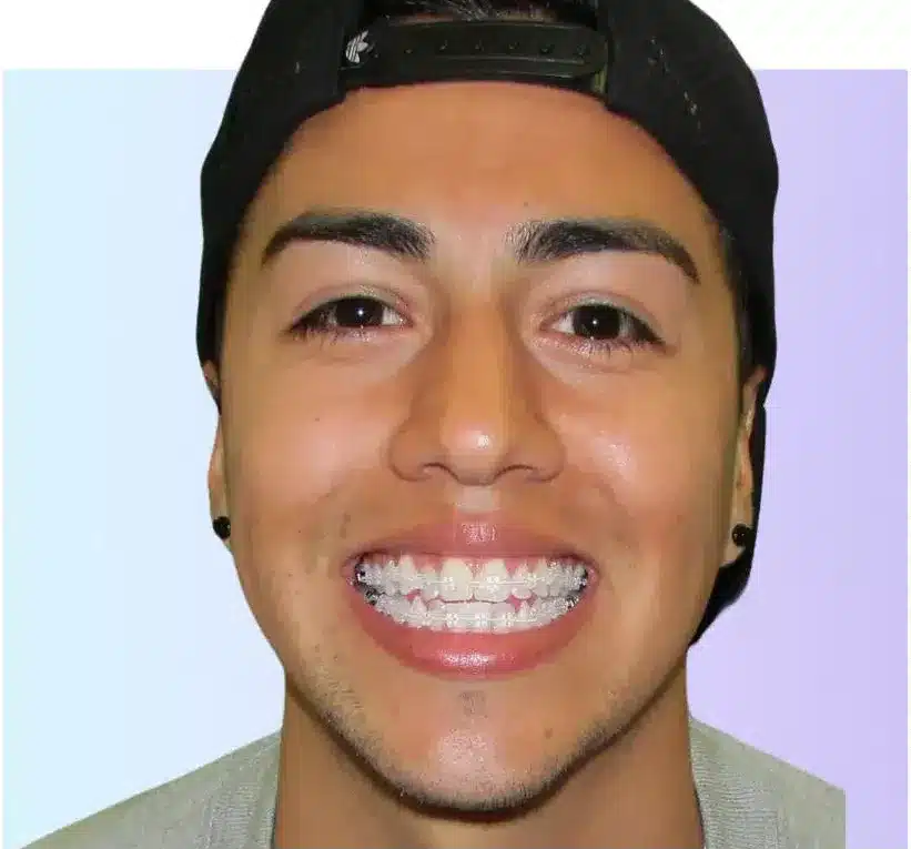man with clear braces